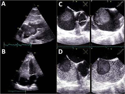 Case report and literature review: cardiac hematic cyst